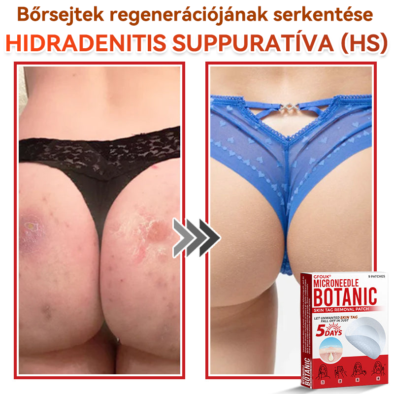 ✅ GFOUK® Mikrotűs növényi bőrkinövés eltávolító tapasz