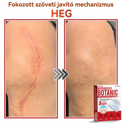 ✅ GFOUK® Mikrotűs növényi bőrkinövés eltávolító tapasz