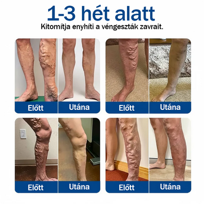 ✅🇭🇺👨‍⚕️TAILEDEN® VeinEase Mikrotűs Kezelő Tapasz⚡Azonnali Megkönnyebbülés, Hosszú Távú Eredmények