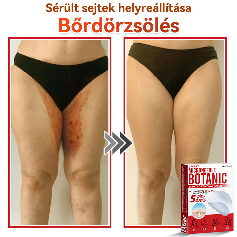 ✅ GFOUK® Mikrotűs növényi bőrkinövés eltávolító tapasz