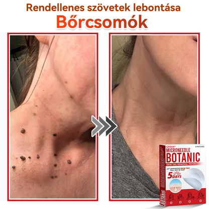✅ GFOUK® Mikrotűs növényi bőrkinövés eltávolító tapasz