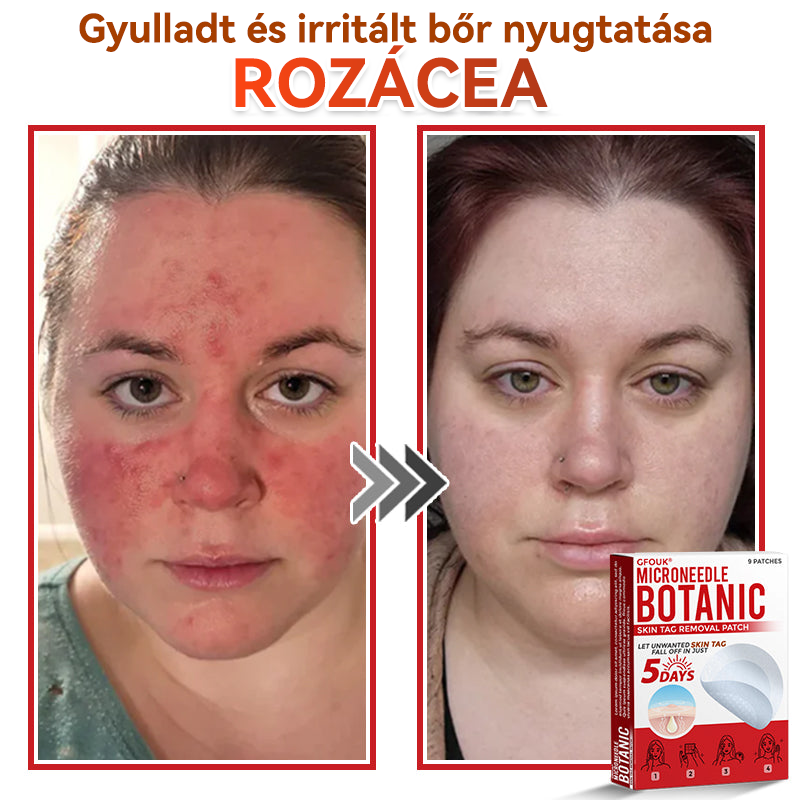✅ GFOUK® Mikrotűs növényi bőrkinövés eltávolító tapasz