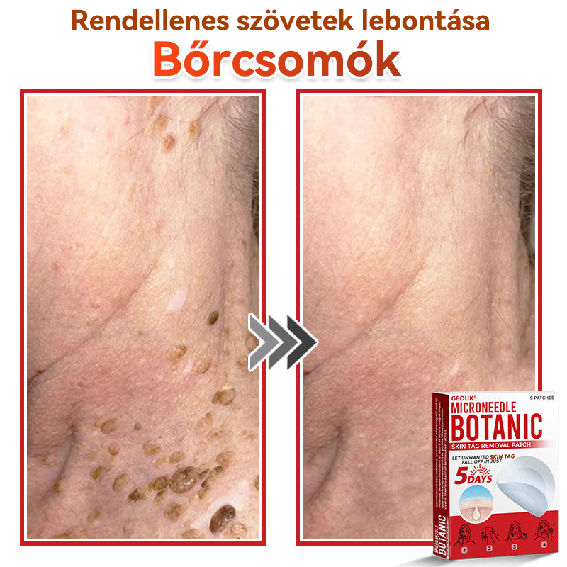 ✅ GFOUK® Mikrotűs növényi bőrkinövés eltávolító tapasz