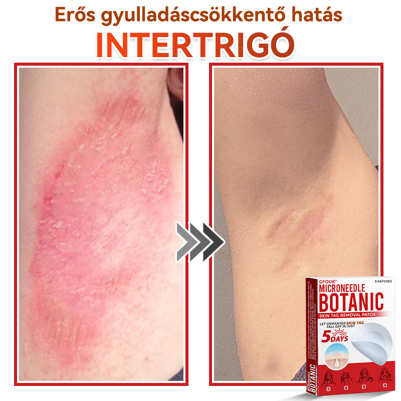 ✅ GFOUK® Mikrotűs növényi bőrkinövés eltávolító tapasz